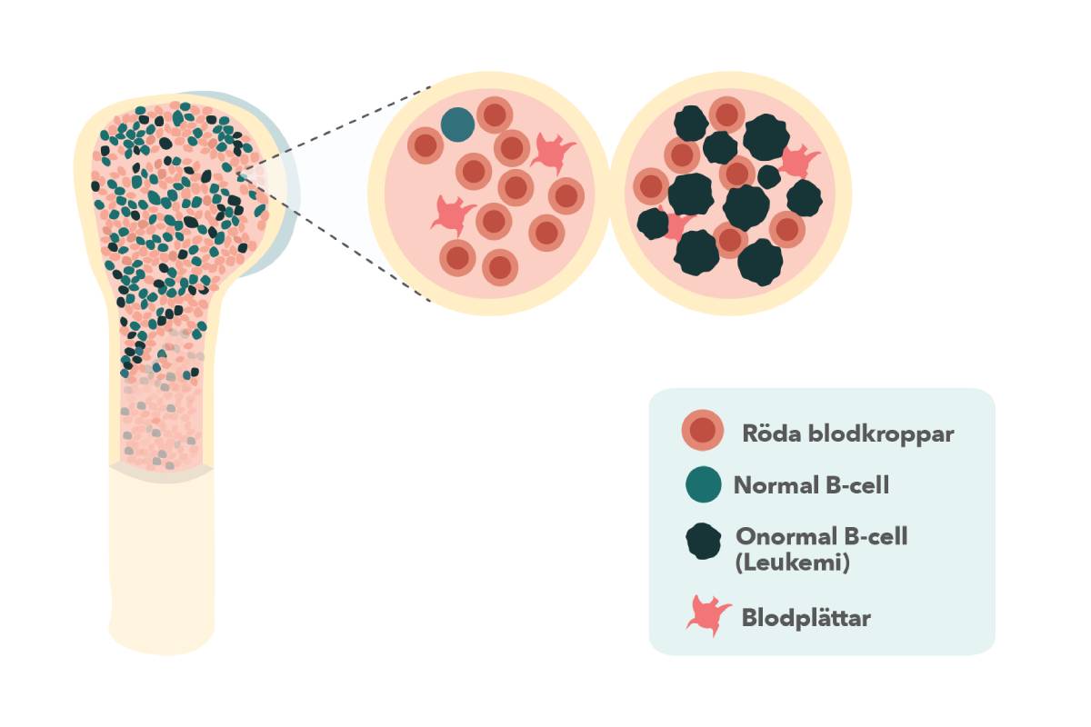 Bild på benmärg, med två förstoringar. I den ena förstoringen finns röda blodkroppar, en normal B-cell, och blodplättar. I den andra förstoringen finns onormala B-celler (Leukemi), som tränger ut de röda blodkropparna och blodplättarna.
