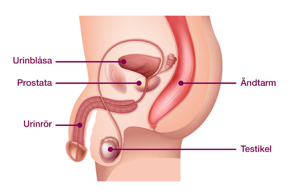 Genomskärning av manligt könsorgan. Fem pilar med tillhörande text pekar på urinblåsa, prostata, urinblåsa, ändtarm och testikel